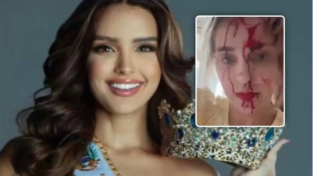 Sulmohet Miss Venezuela, publikon fytyrën e përgjakur